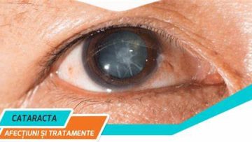 cataracta