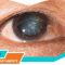 cataracta