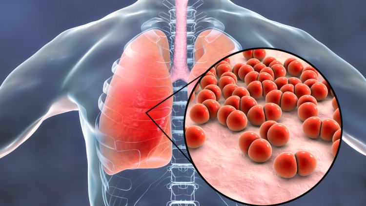 pneumonie